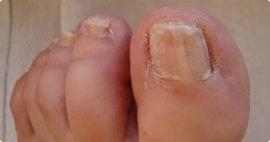 Nagelpilz an mehreren Zehennägeln
