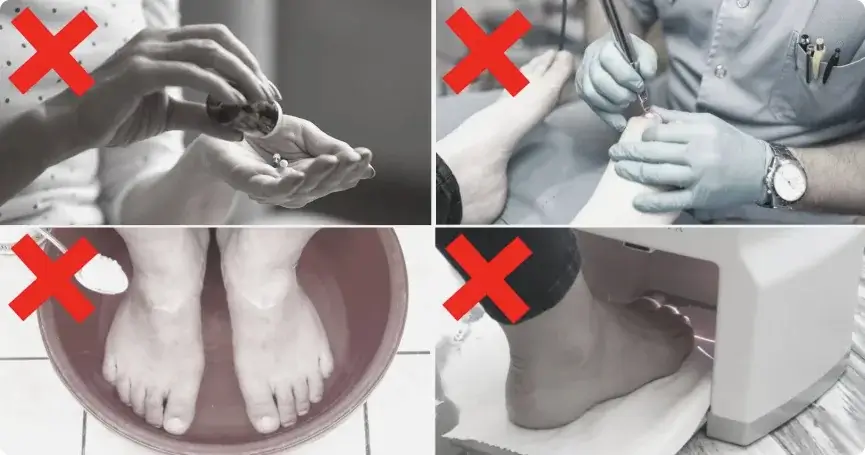 Häufige Fehler bei der Behandlung von Nagelpilz