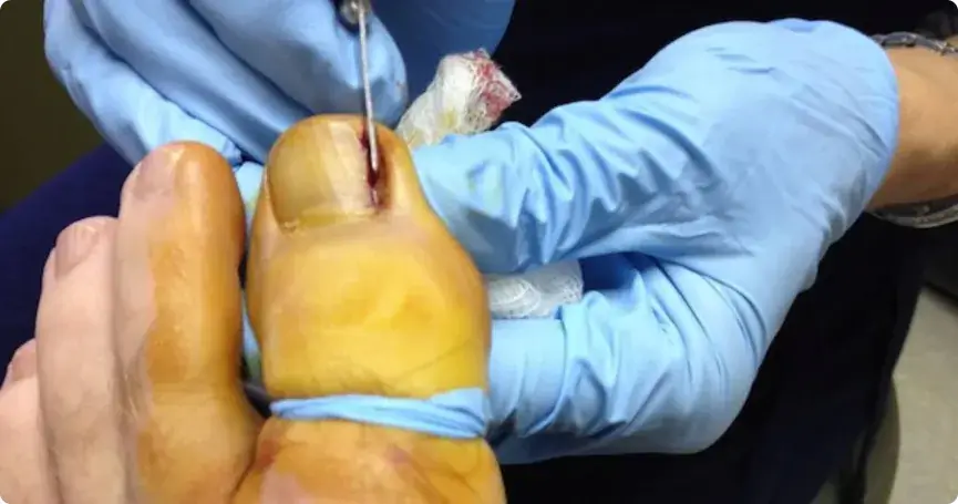 Behandlung eines erkrankten Zehennagels